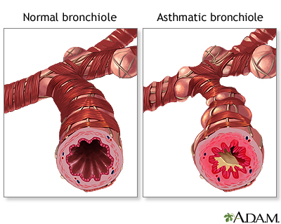 Asthma airway NIH image