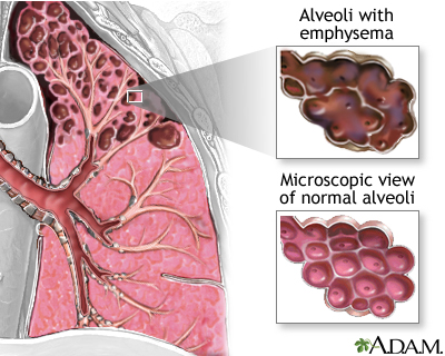 Emphysema NIH image