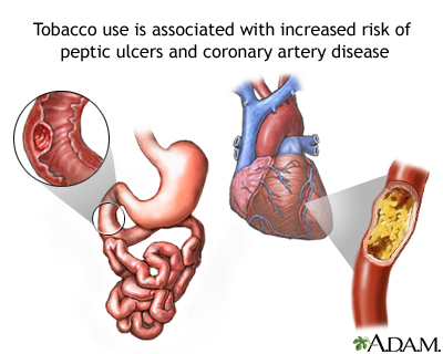 Tobacco ulcers and CAD NIH image